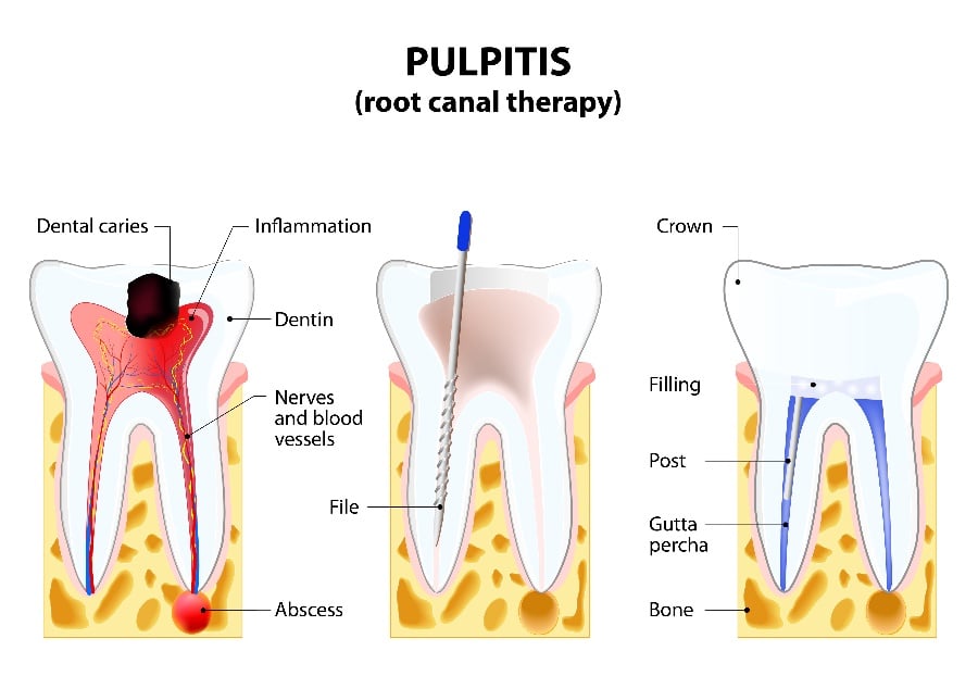 What is a Root Canal