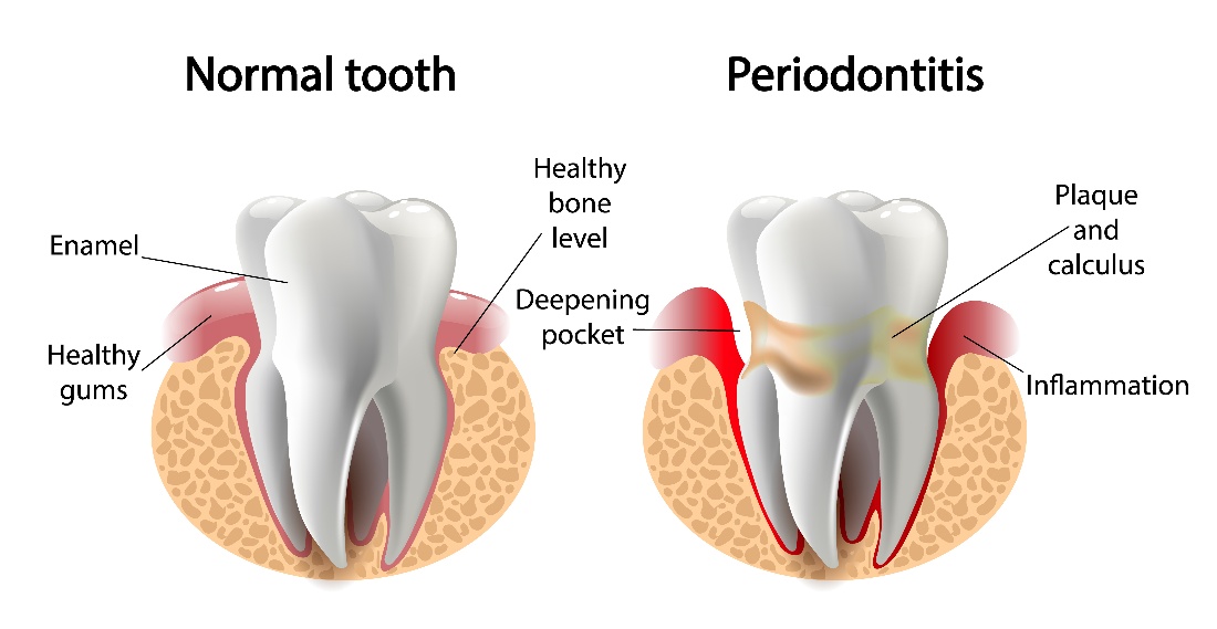 Implants and Periodontal Disease