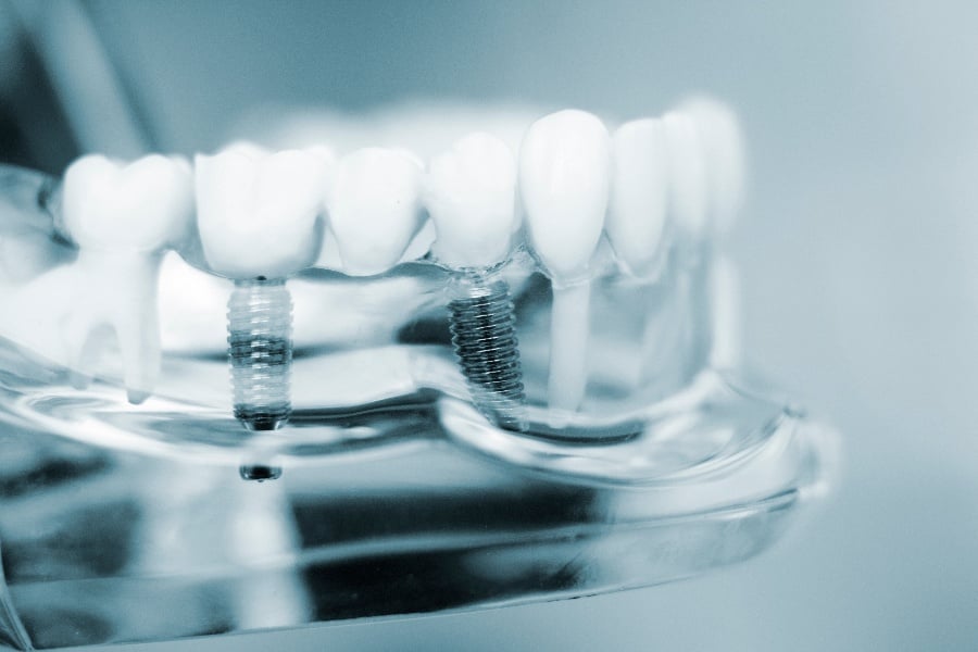 How Long Do Dental Implants Take To Heal