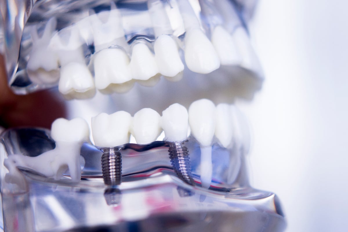 All on Four Dental Implants: The Solution for Bone Loss and Missing Teeth