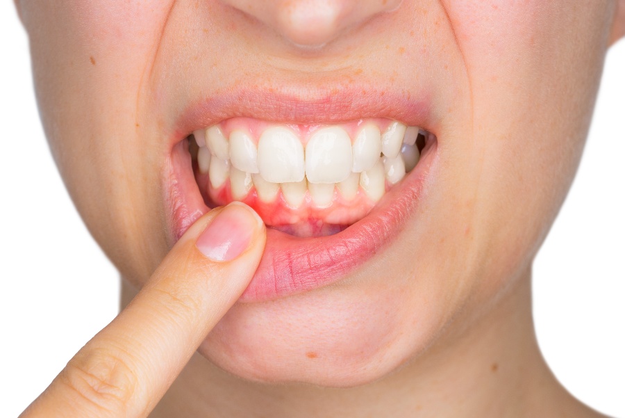 Bleeding Gums a Sign of Gum Disease