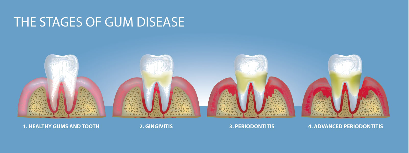 The Importance of Early Detection and Treatment of Gum Disease
