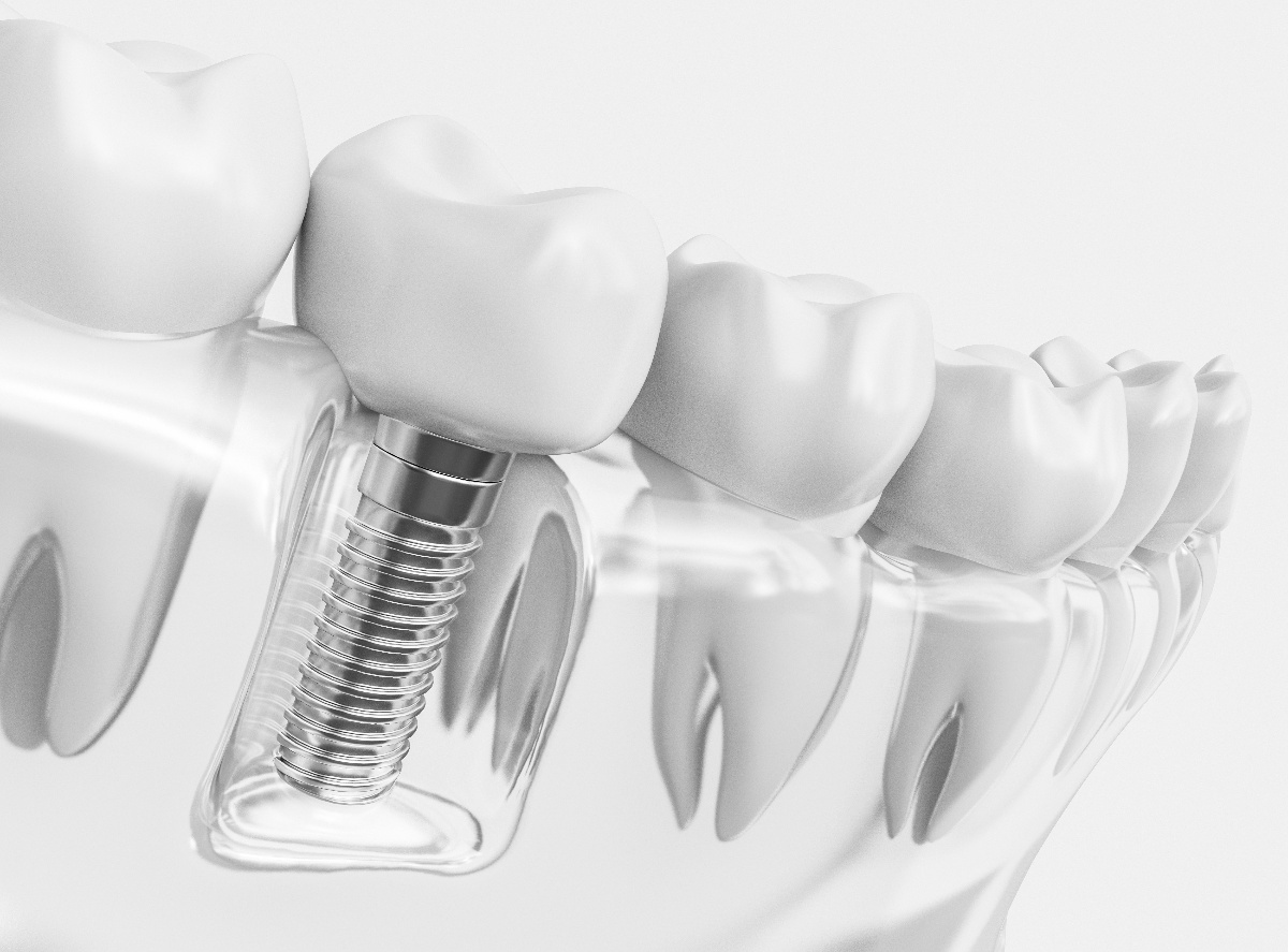 Oral Health With Dental Implants