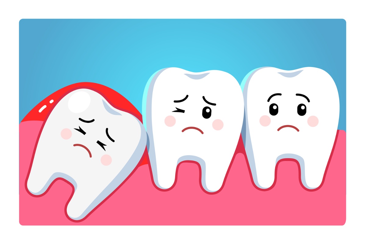 Wisdom Teeth Removal: When Is the Best Time to Have Them Removed?