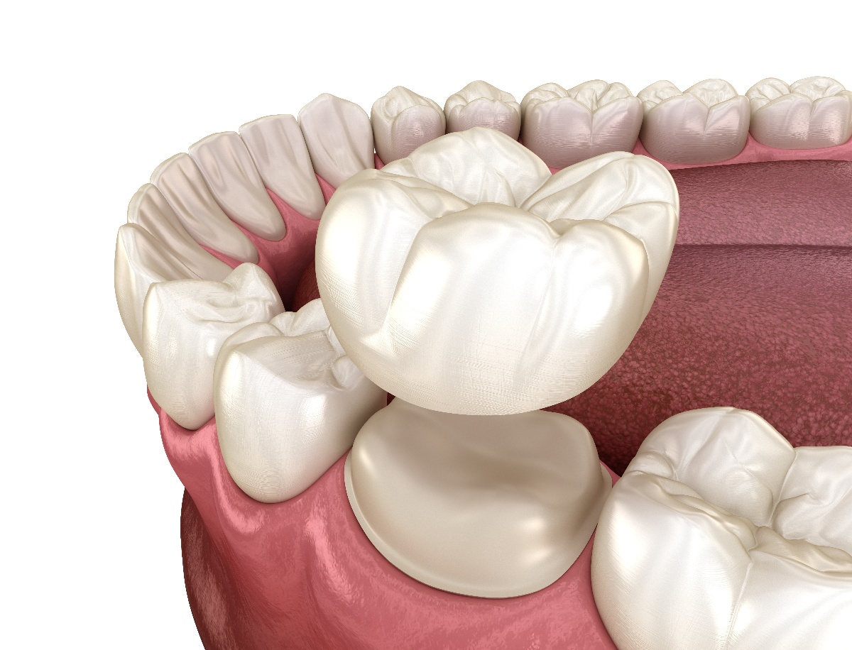 How Porcelain Crowns Can Transform Your Teeth and Boost Your Confidence