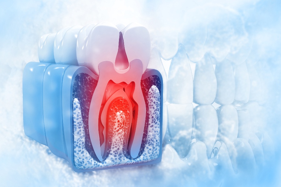 Nine Benefits of Saving a Natural Tooth with Root Canal Treatment