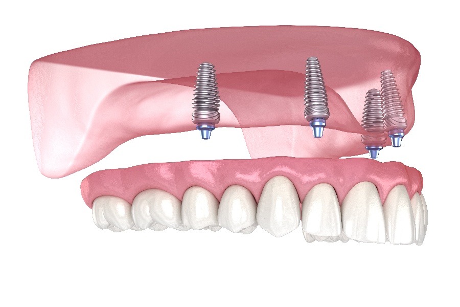 All-On-Four dental implants
