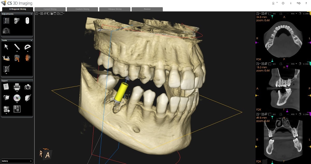 How CBCT Technology Enhances Precision in Dental Diagnosis