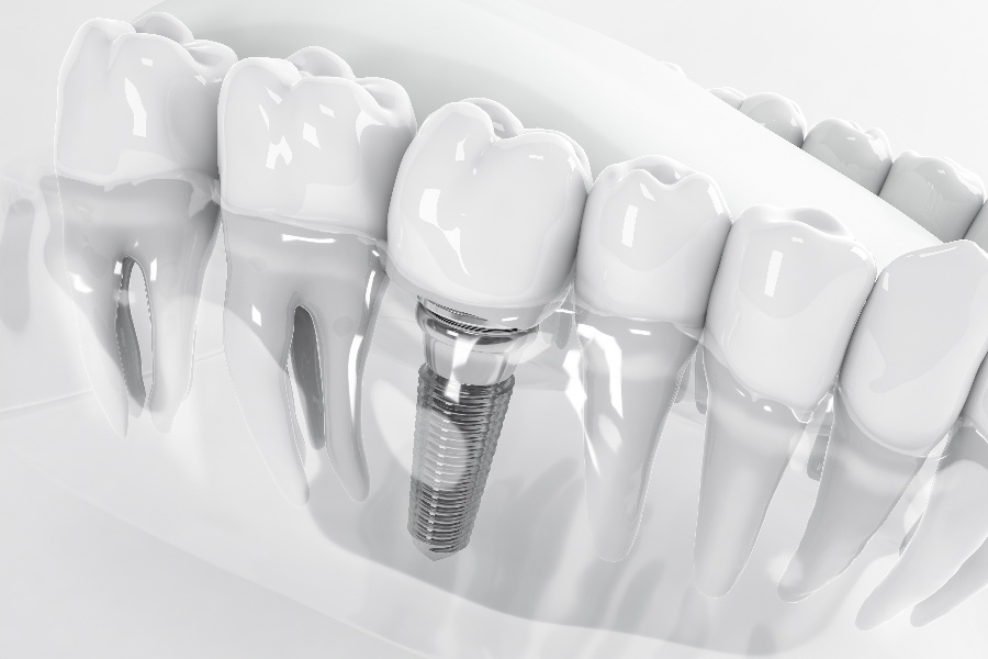 Dental Implant Myths