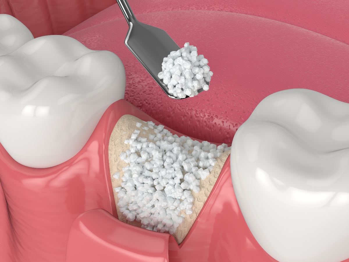 Dental Bone Graft: Process, Healing and What It Is