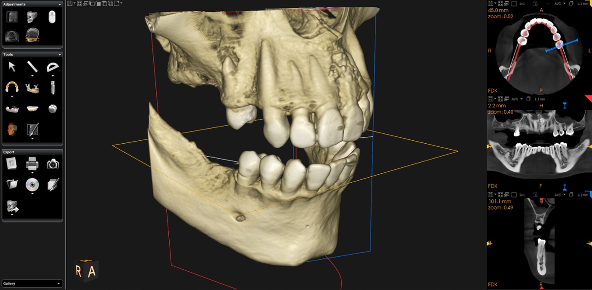 The Role of CBCT Imaging in Dental Implants