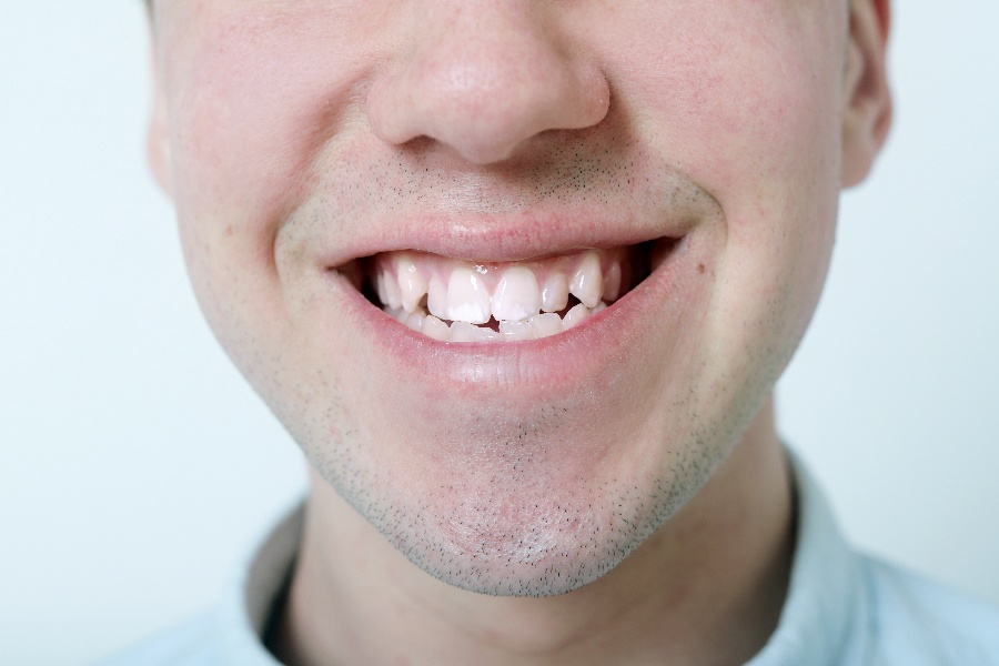 The Benefits of Having Aligned Teeth