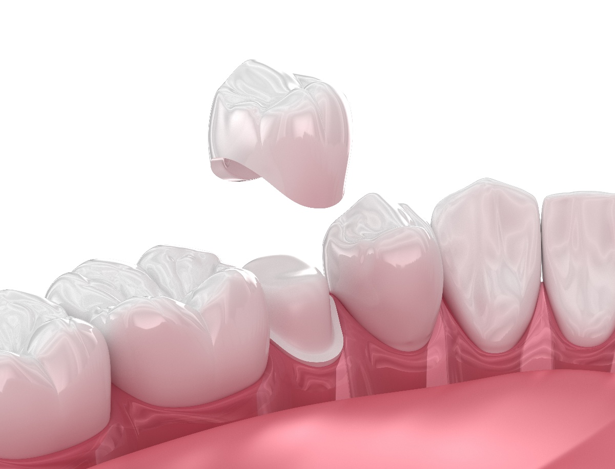 dental crowns