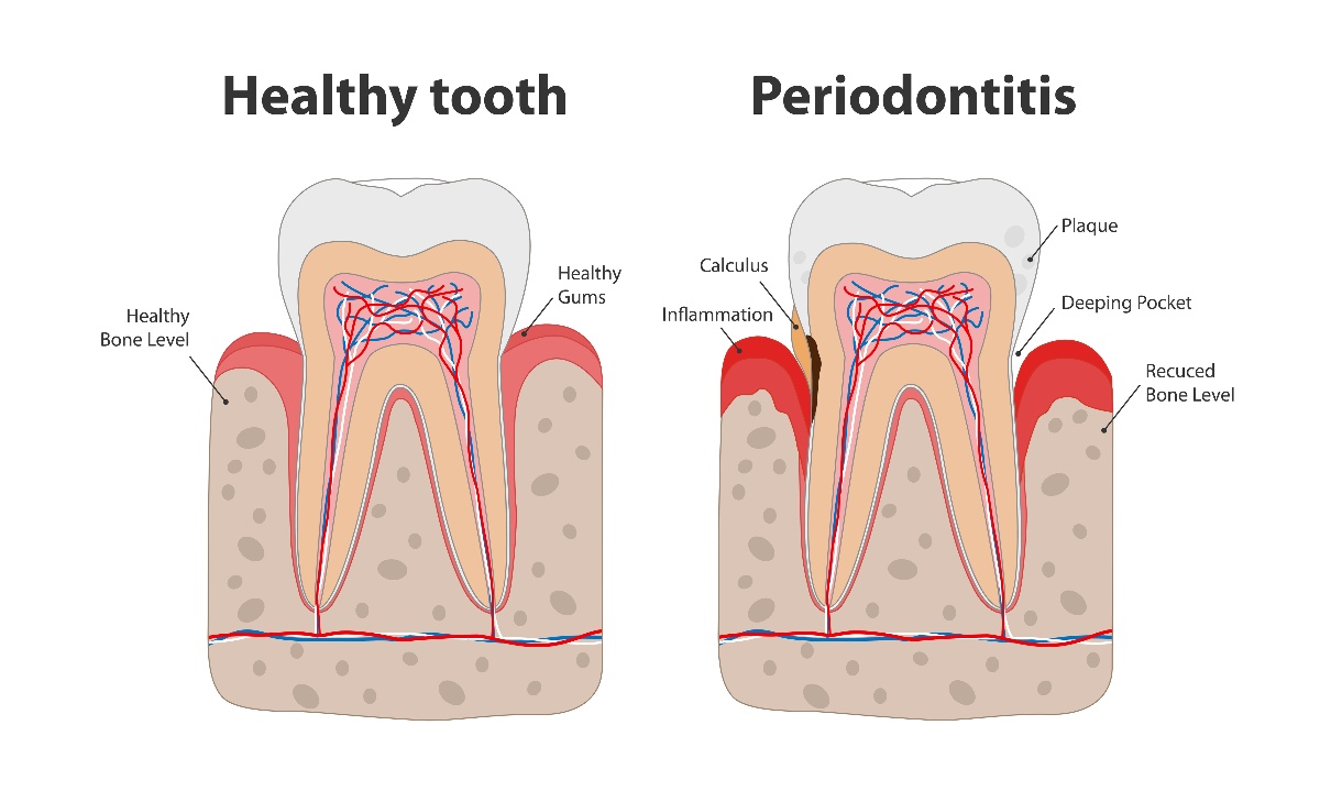 Periodontal Disease Can Cause Serious Health Issues