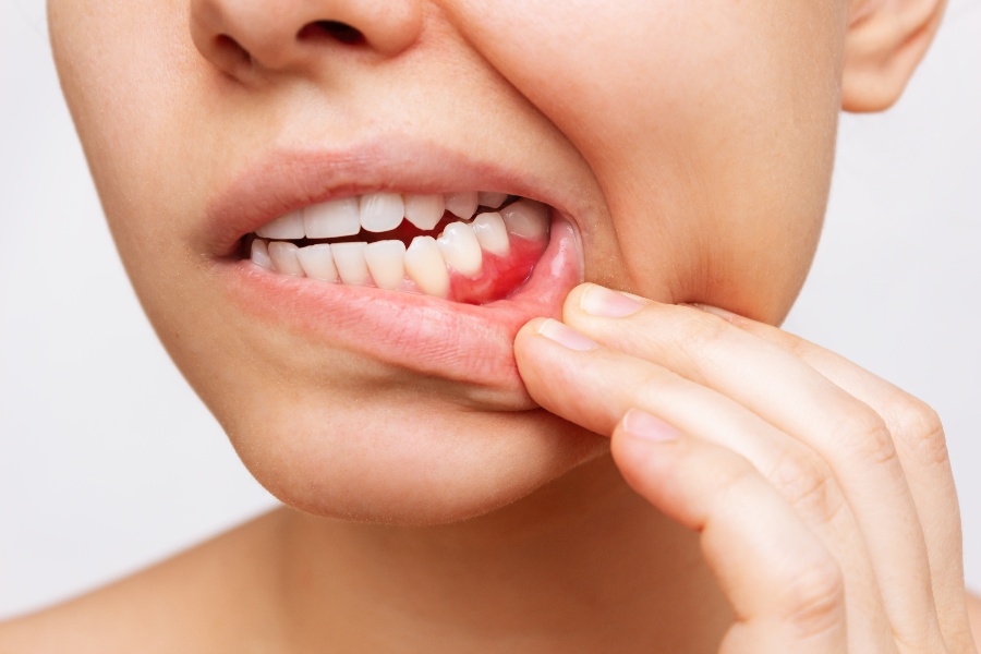 What Are Bleeding Gums a Sign Of?